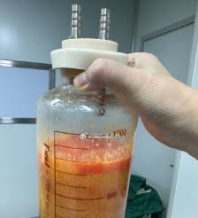 黄石水动力吸脂手术要做多久？